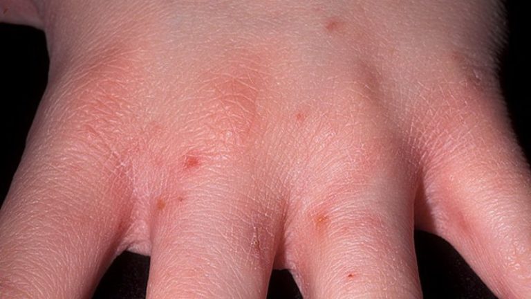 Чесотка у кошек